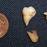 Wisdom tooth
